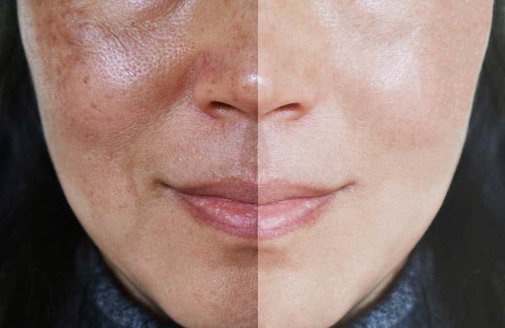 Pigmentation Treatment